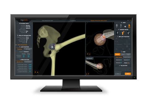 3D Surgical Planning: