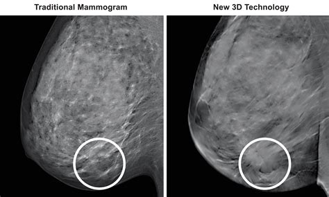 3D mammography: