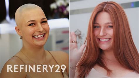 40,000+ People Are Wearing Wigs for Alopecia: Here's Why!