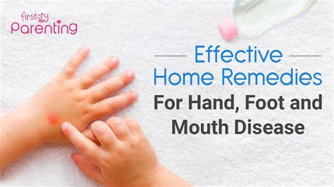 5 Amazing Hand, Foot, and Mouth Disease: Home Remedies for Itching in 2025