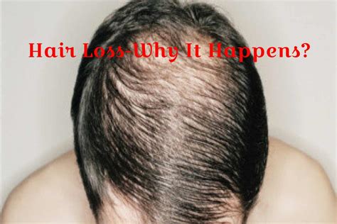 5 Compelling Reasons Why Hair Replacement for Women is Experiencing an Unprecedented Surge