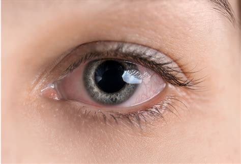 5 Critical Facts About Swollen Inner Corner of Eye