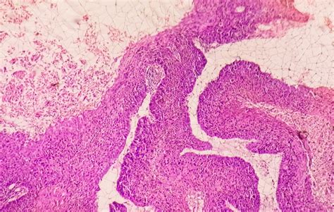 5 Essential Facts About Squamous Cell Carcinoma of the Tongue