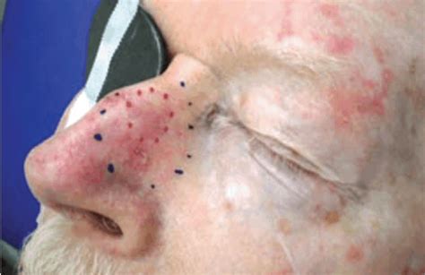 5 Vital Signs of Squamous Cell Carcinoma on Nose That Demand Action