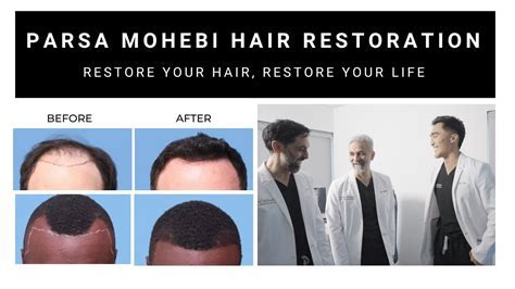 5-Hook Toupee System: The Revolutionary Solution for Hair Loss