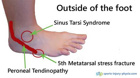 50% of runners experience foot pain