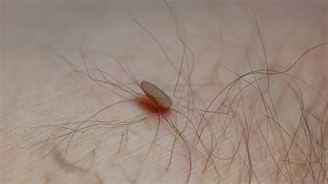 6 Frightening Cancerous Skin Tags Pictures You Need to See Today