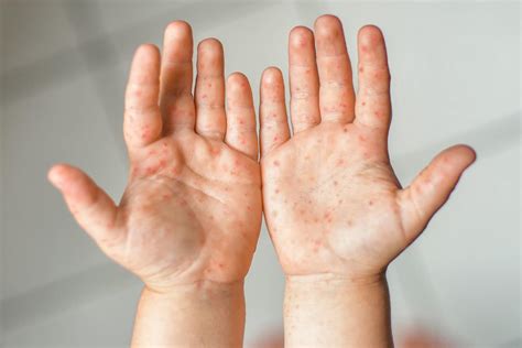 6 Signs You May Have Hand, Foot, and Mouth Disease as an Adult