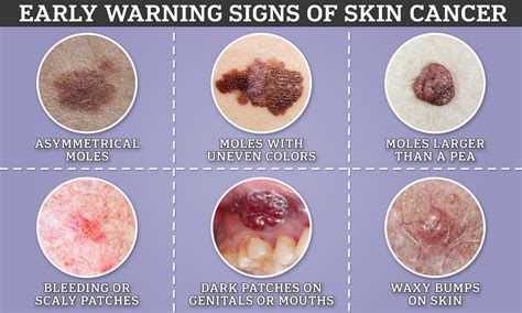 6 Signs of Cancerous Skin Tags