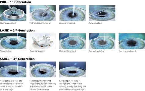 7+ Laser Vision Correction Options: