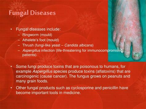 7 Eye-Catching Types of Fungal Infections with Enticing Pictures