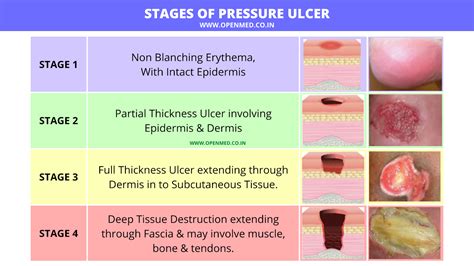 7 Scary Stage 3 Pressure Ulcer Pictures