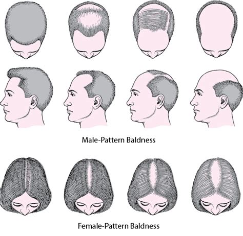 8 Causes of Hair Loss on Top of Head