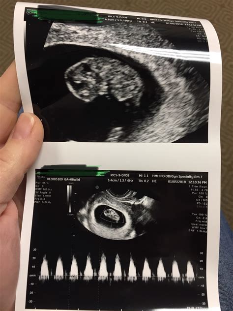 8 Week Ultrasound: Exploring the Wonders at 8 Weeks 5 Days