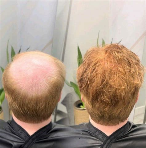 99.99% Pain-Free Hair Replacement Methods for Men