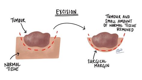 A Comprehensive Guide to Fibrous Papule Removal: Treatment Options, Risks, and Recovery