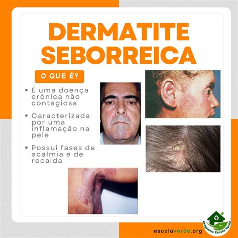 A Dermatite é Contagiosa?