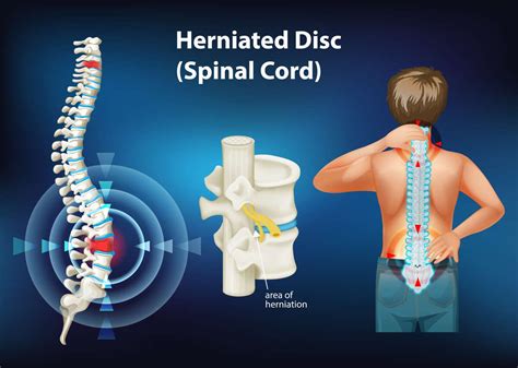 A Herniated Disc Leaning Left: Symptoms, Diagnosis, and Treatment Options in 2025