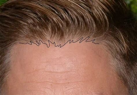 A natural-looking hairline: