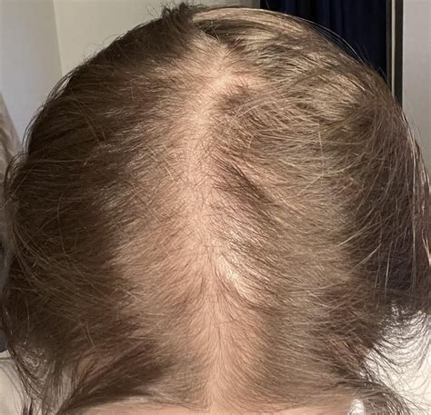 AMK Stands for Androgenetic Alopecia