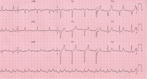 AV Block Type 1: A Comprehensive Guide to Its Causes, Symptoms, and Management