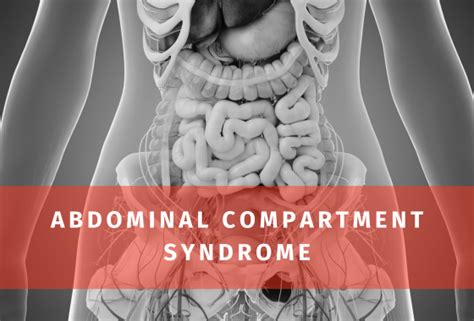 Abdominal Compartment Syndrome: An Insider's Guide (12,000+ Words)