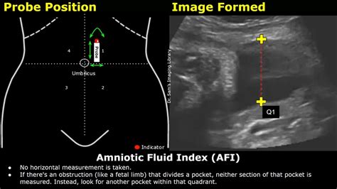 Abdominal Function Index (AFI):