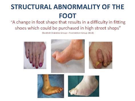 Abnormality in hoof shape: