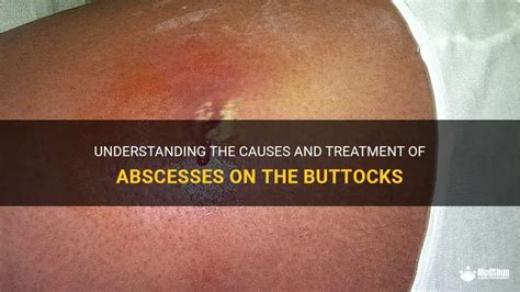 Abscess of the Buttocks: A Comprehensive Guide