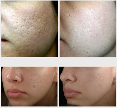 Acne and Scar Reduction: