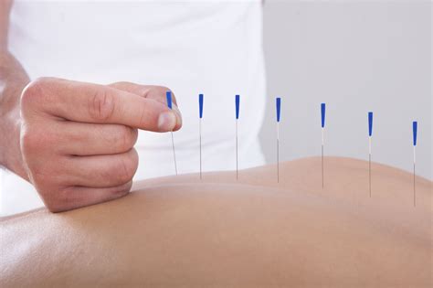 Acupuncture for Pain Relief: