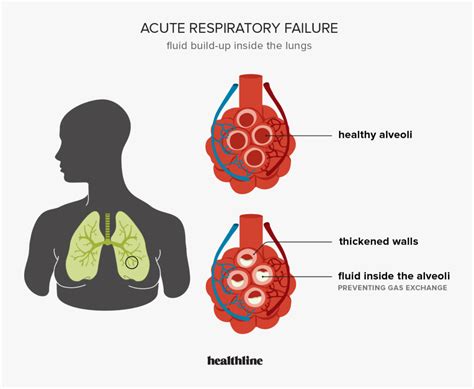 Acute respiratory failure: