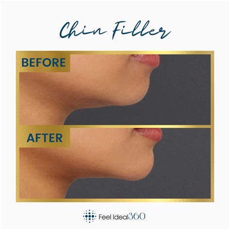 Add Volume at the Chin: