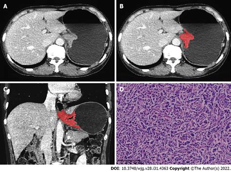 Adenocarcinoma of the Esophagogastric Junction Reader