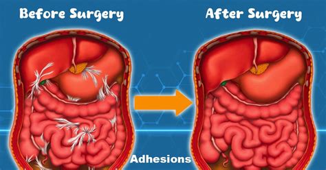 Adhesions: