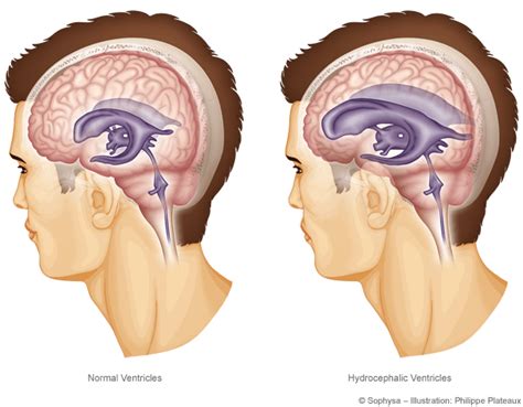 Adult Hydrocephalus Kindle Editon