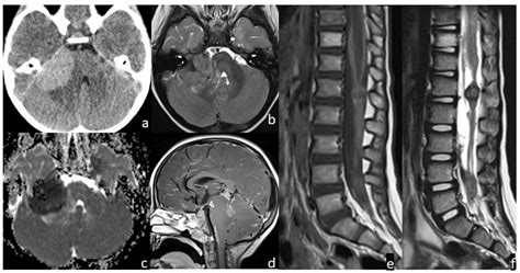 Advanced Techniques in Central Nervous System Metastases Doc