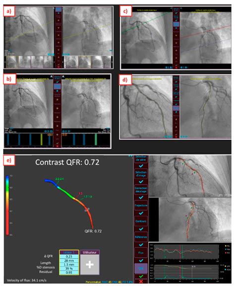Advances in Quantitative Coronary Arteriography Reader