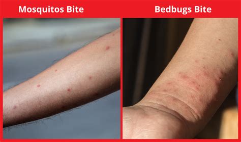 After Dengue Mosquito Bite: Everything You Need to Know