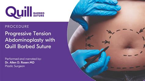 Allen by ABS: Empowering the Future of Abdominoplasty