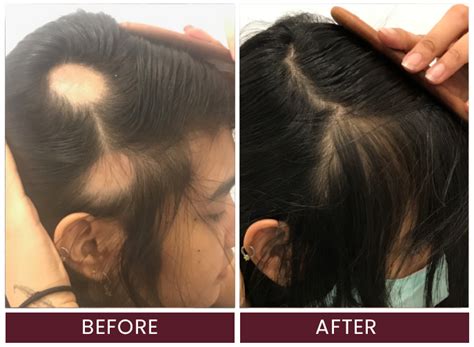 Alopecia and Other Hair Loss Conditions: