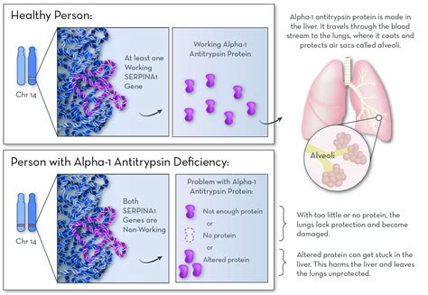 Alpha-1-Antitrypsin Deficiency Pathophysiology Doc