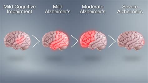 Alzheimer's Disease A Guide to Diagnosis Epub