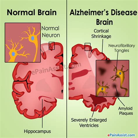 Alzheimer's disease: