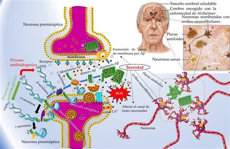 Amiloide-beta: O vilão oculto do Alzheimer