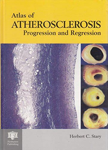 An Atlas of Atherosclerosis Progression and Regression Kindle Editon