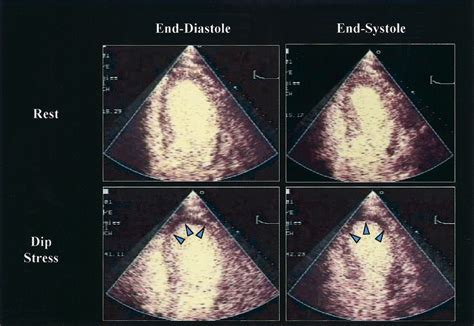 An Introduction to Stress Echocardiography Reader