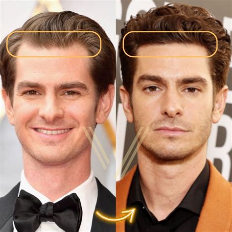 Andrew Garfield Hair Transplants: A Journey to Revitalized Hair