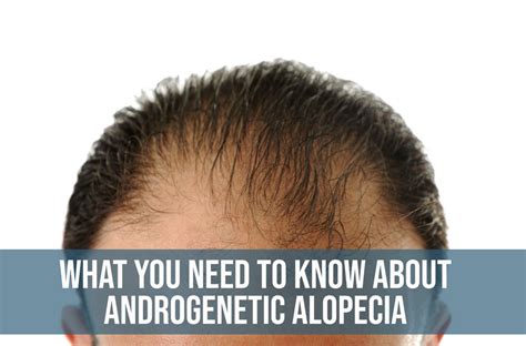 Androgenetic alopecia