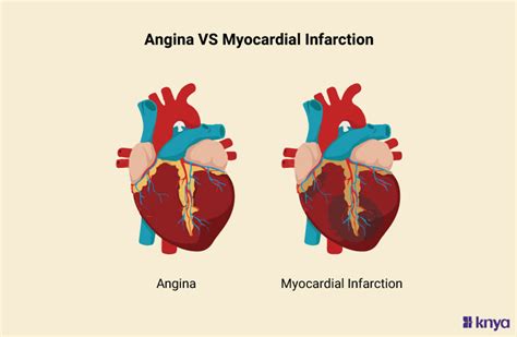 Angina vs Anxiety: How to Tell the Difference in 2025